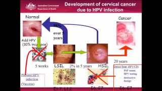 Cervical Cancer Screening Is this the end of the pap smear [upl. by Deste]