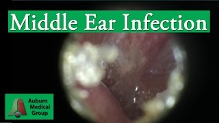 Ear Infection Pain Treatment in an Adult  Auburn Medical Group [upl. by Fawn]