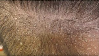 SCALP PSORIASIS FLAKING ALLOVER [upl. by Terris740]