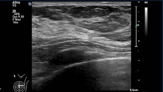 Breast Ultrasound  normal anatomy [upl. by Adnirual]