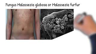 Skin fungal infection Tinea versicolor symptoms causes Treatment [upl. by Martsen]