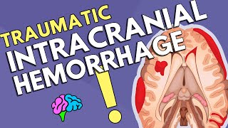 Intracranial Hemorrhage [upl. by Julieta]