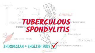 Tuberculous Spondylitis Overview and Treatment [upl. by Ennovyhs]