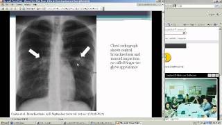 Allergic Bronchopulmonary Aspergillosis Heather Doss MD [upl. by Ylen]