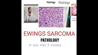 Bone tumor Pathology Ewing Sarcoma [upl. by Zakaria]