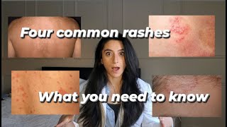 Four common rashes and everything you need to know about them [upl. by Satterlee]