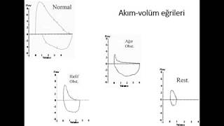 Solunum Fonksiyon Testi sonuçlarının yorumlanması dersi [upl. by Kushner]