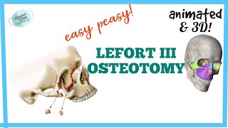 LEFORT III OSTEOTOMY  MAXILLARY OSTEOTOMY [upl. by Ydur221]