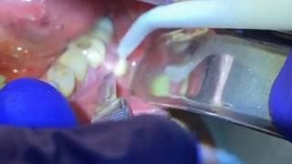 Draining a Dental Abscess  Advanced Dental Care [upl. by Aimit537]