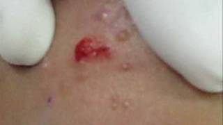 Treatment of Molluscum Contagiosumwmv [upl. by Ebbie]