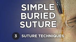 Simple Buried Suture  Learn Suture Techniques [upl. by Breanne374]