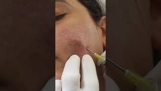 Subcision for Acne Scarring [upl. by Endora]