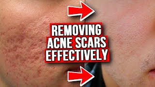 GET RID OF ACNE SCARS FROM EXPERIENCE [upl. by Rush]