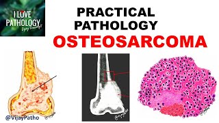 OSTEOSARCOMA Clinical  Radiological features amp Morphology [upl. by Melisandra]