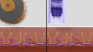 Dermapen v Dermaroller [upl. by Addi]