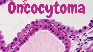 Renal Oncocytoma  Pathology mini tutorial [upl. by Minnie]