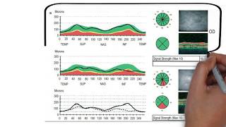 Optical Coherence Tomography  OCT  part1 [upl. by Ahsuas99]