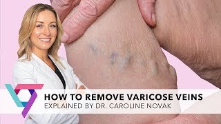 Medical Clinic How To Remove Varicose Veins explained  Vein Treatment Center New York 10017 [upl. by Lehar702]