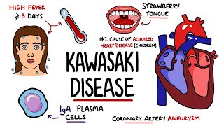 Kawasaki disease  an Osmosis Preview [upl. by Uriisa]