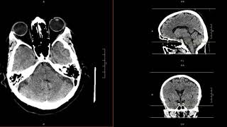 Intracranial Contents Part 4 Brain Parenchyma [upl. by Stegman]