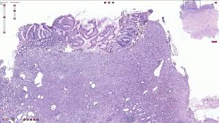 Histopathology ColonVillous adenoma [upl. by Eladnar989]