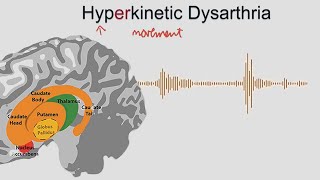 Hyperkinetic Dysarthria  samples and explanation [upl. by Saunderson]