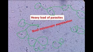 Heavy load of parasites in stool Stool microscopic examination Trichomonas hominis [upl. by Farny]