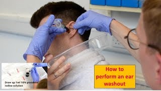 How to Perform an Ear Washout irrigation  ENTOtolaryngology Skills [upl. by Schick]