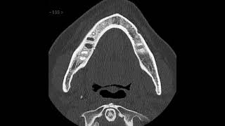 Osteomielite de mandíbula [upl. by Berty]
