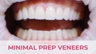 Minimal Preparation Porcelain Veneers Smile Transformation [upl. by Naples]