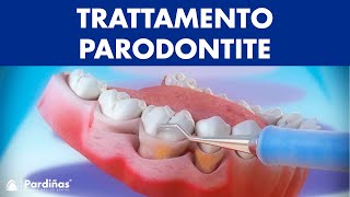 Trattamento parodontite – Curettage e sondaggio parodontale © [upl. by Cope]