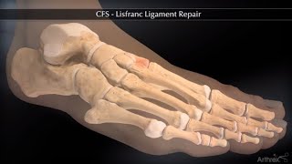 CFS Lisfranc Ligament Repair [upl. by Bevan196]