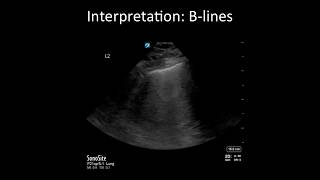 Lung Ultrasound Common Pitfalls [upl. by Inajar]