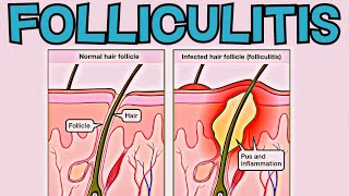 What is Folliculitis Folliculitis EXPLAINED in 2 Minutes  Signs Symptoms Cause Treatment [upl. by Nobie371]