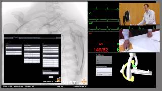 Superior Mesenteric Artery SMA Angiogram [upl. by Hort]