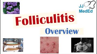 Folliculitis  Causes Bacterial Fungal Viral Risk Factors Symptoms Diagnosis Treatment [upl. by Nodnart]