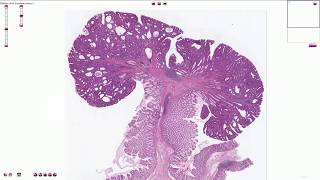 Tubular adenoma  Colon  Histopathology [upl. by Eelyah]