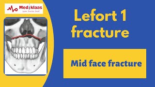 Le Fort I Fracture l Mid face fracture l Oral surgery l Mediklaas [upl. by Tichonn]