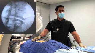 Radiofrequency Ablation Procedure [upl. by Fabrin]