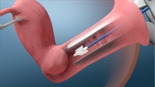 Demonstration of EndoSee [upl. by Nnaear]