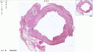 Chronic Cholecystitis  Histopathology [upl. by Trinidad337]