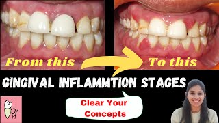 GINGIVITIS ‖ Stages Of Gingival Inflammation ‖ Perio Hub ‖ Dr Sneha [upl. by Farman]