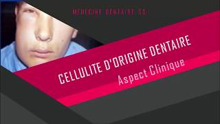 Cellulite dorigine dentaire  Part 1 [upl. by Asiuol]