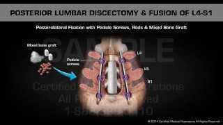 Posterior Lumbar Discectomy amp Fusion of L4S1 [upl. by Hephzipa]