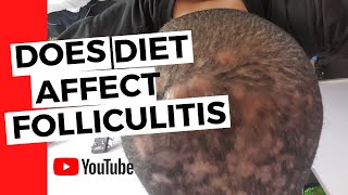 Folliculitis  Does diet affect folliculitis [upl. by Anial]