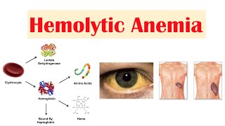 Hemolytic Anemia [upl. by Ludlow219]