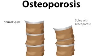 What is Osteoporosis [upl. by Ahasuerus17]