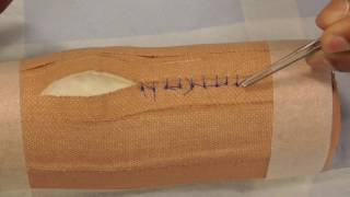 Suture Removal  simple interrupted [upl. by Urissa886]