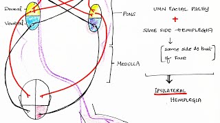 Hemiplegia CVA  Stroke  Theory amp Clinical discussion [upl. by Orecic]