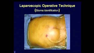 Inguinal Hernia  Surgery  Home Care  Surgeon Dr Imtiaz Hussain [upl. by Justinian889]